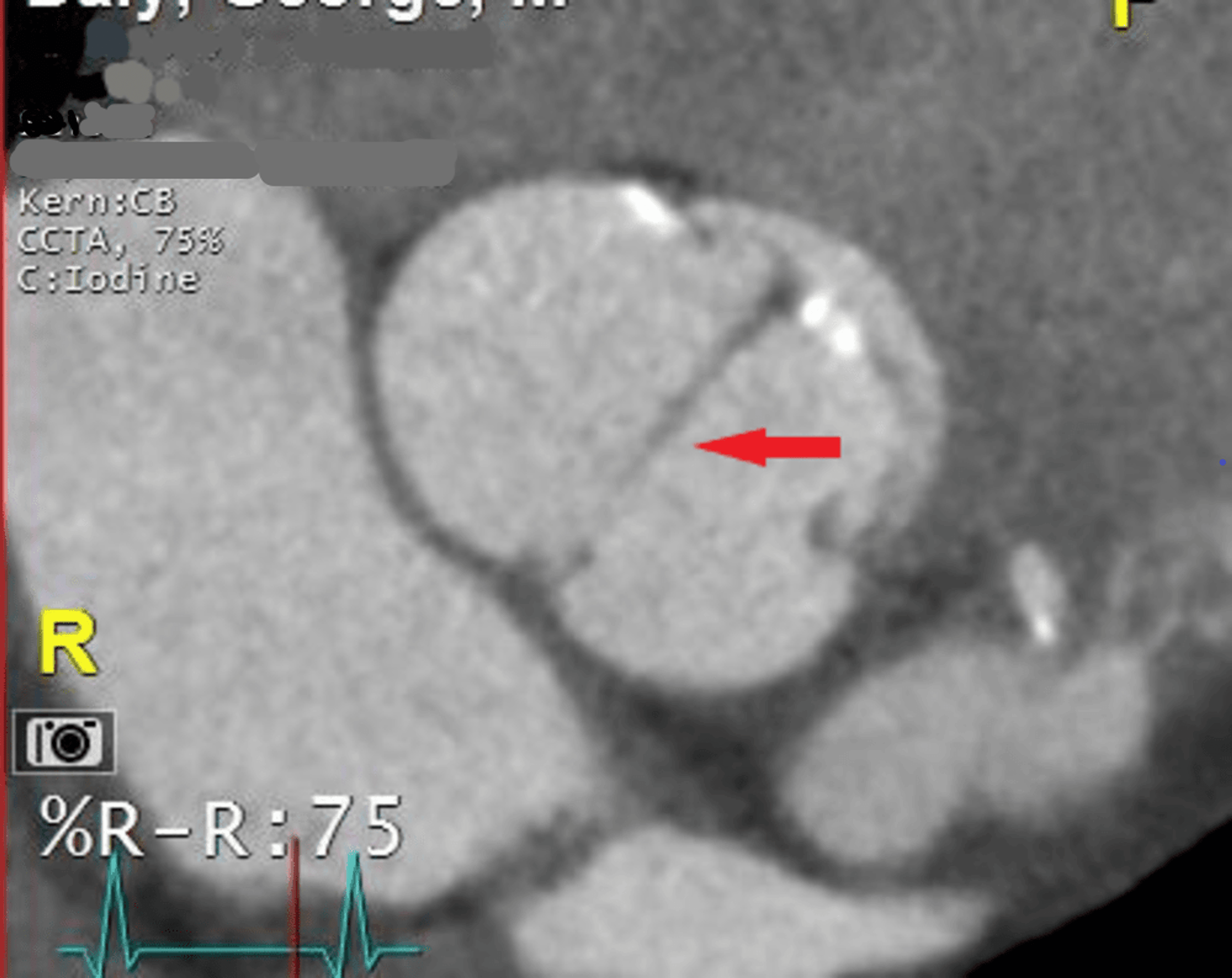 Double Negative Is Positive: Anomalous Aortic Origin of the Left ...