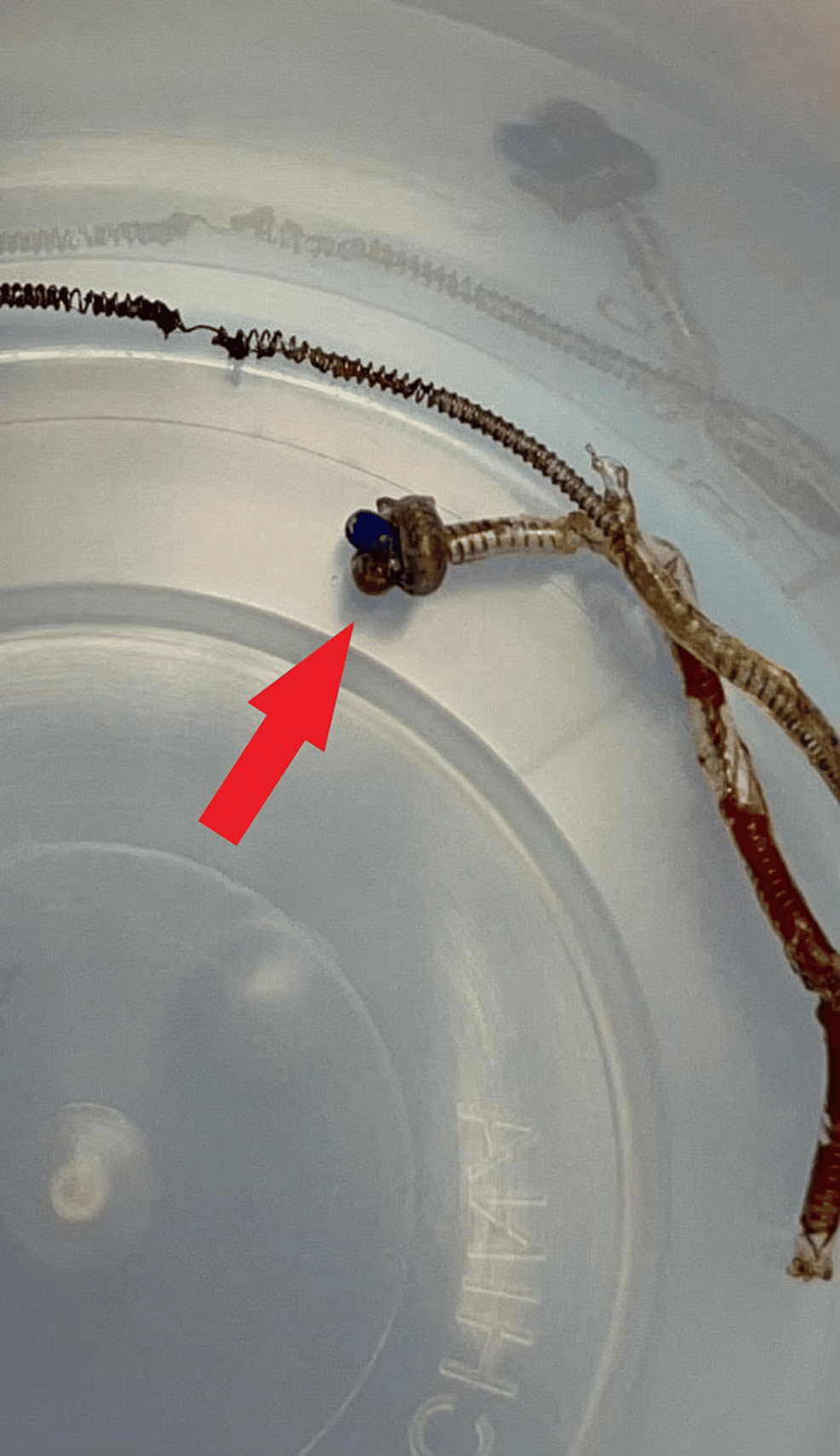 Management of an Entrapped Epidural Catheter Cureus