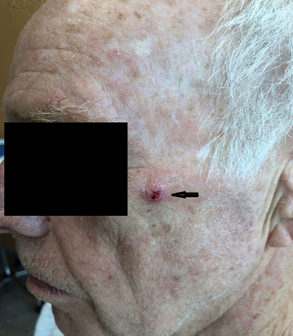 Albums 99 Images Sebaceous Hyperplasia Before And After Photos Completed 