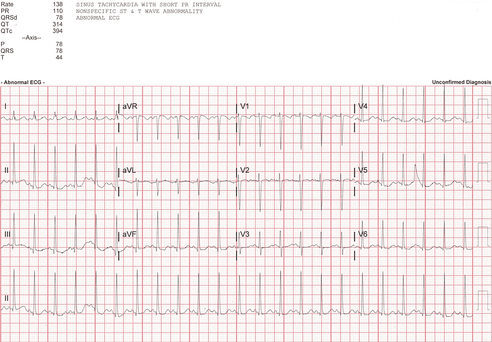 Delayed Serotonin Syndrome and Non-cardiogenic Pulmonary Edema ...