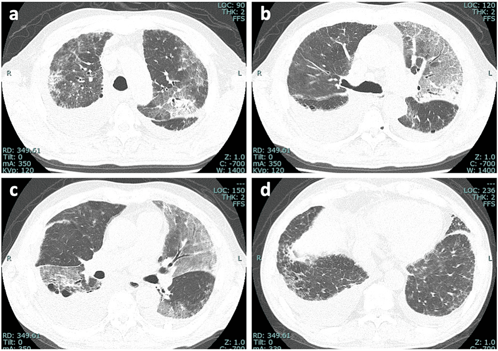 Cureus | Acute Exacerbation of Idiopathic Pulmonary Fibrosis With 