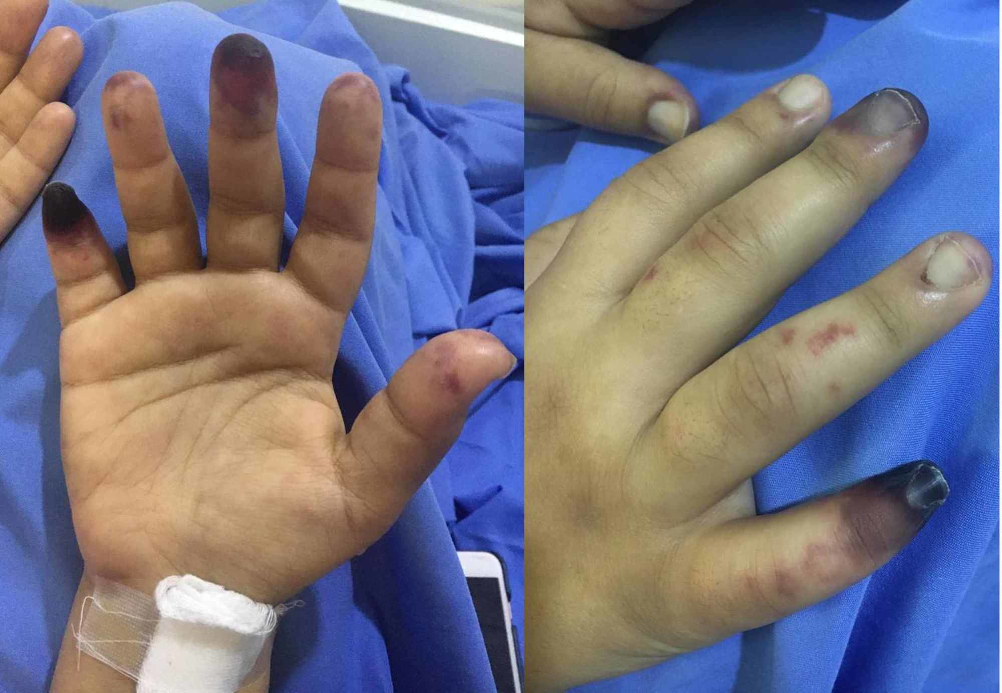 Cureus | Peripheral Gangrene as the Initial Presentation of Systemic