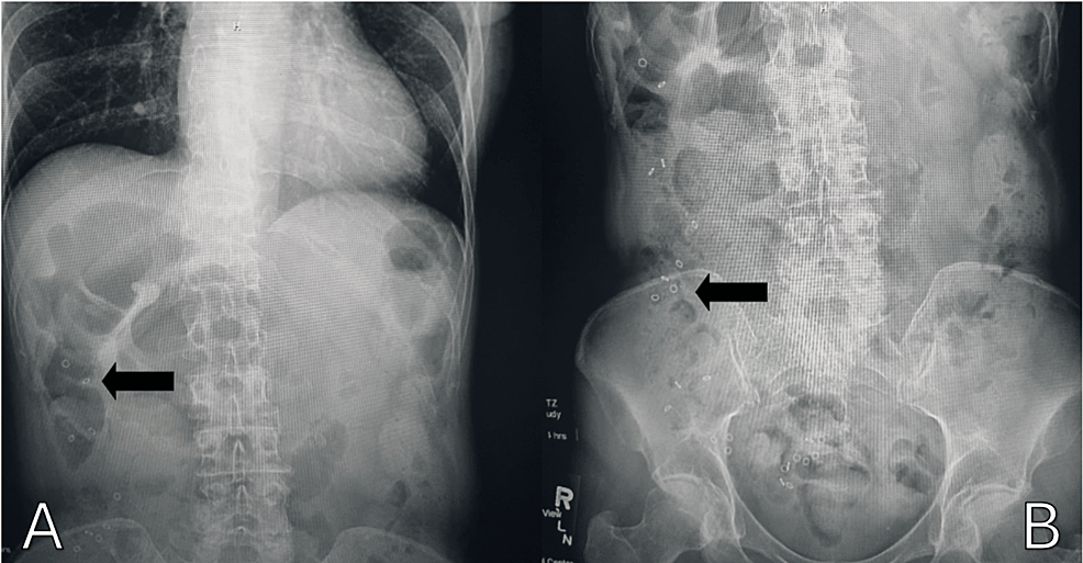 Cureus Chronic Constipation Unmasked A Comprehensive Case Study of
