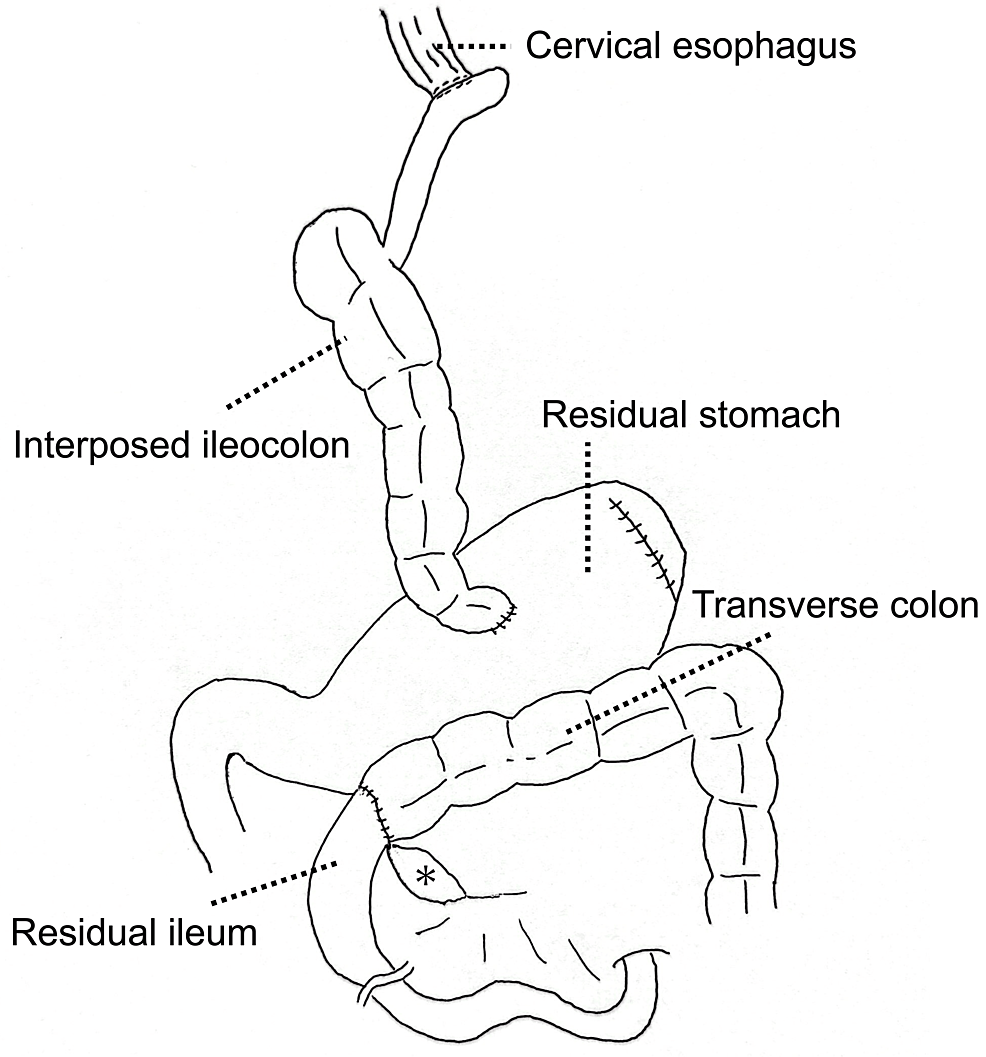 Internal Hernia Through a Mesenteric Defect Following Esophagectomy and ...