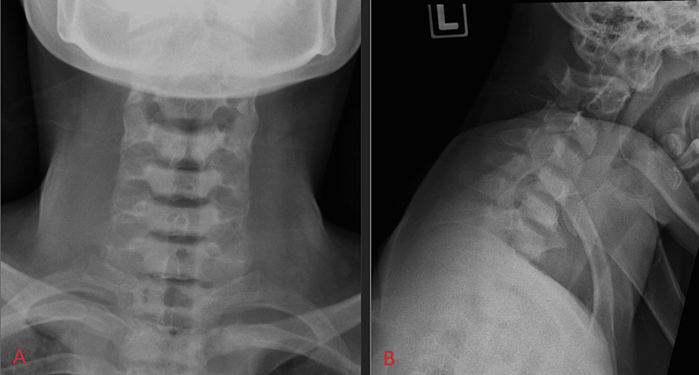 Cureus, Tuberculosis of the Cervical Spine: A Case Report