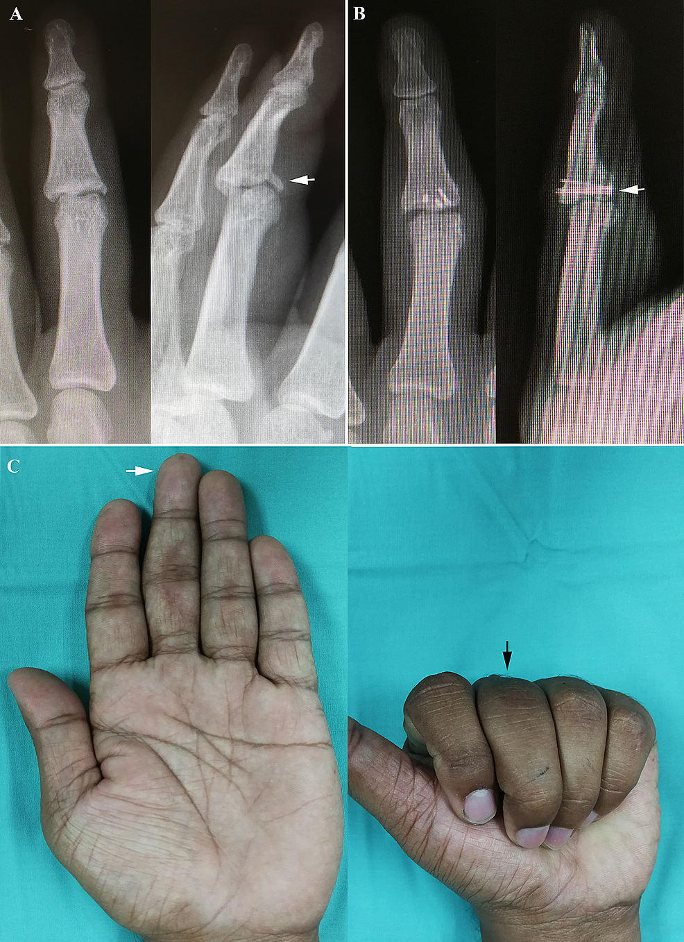 Finger Strap Joint Sprain Fixator Postoperative Fixation Splint