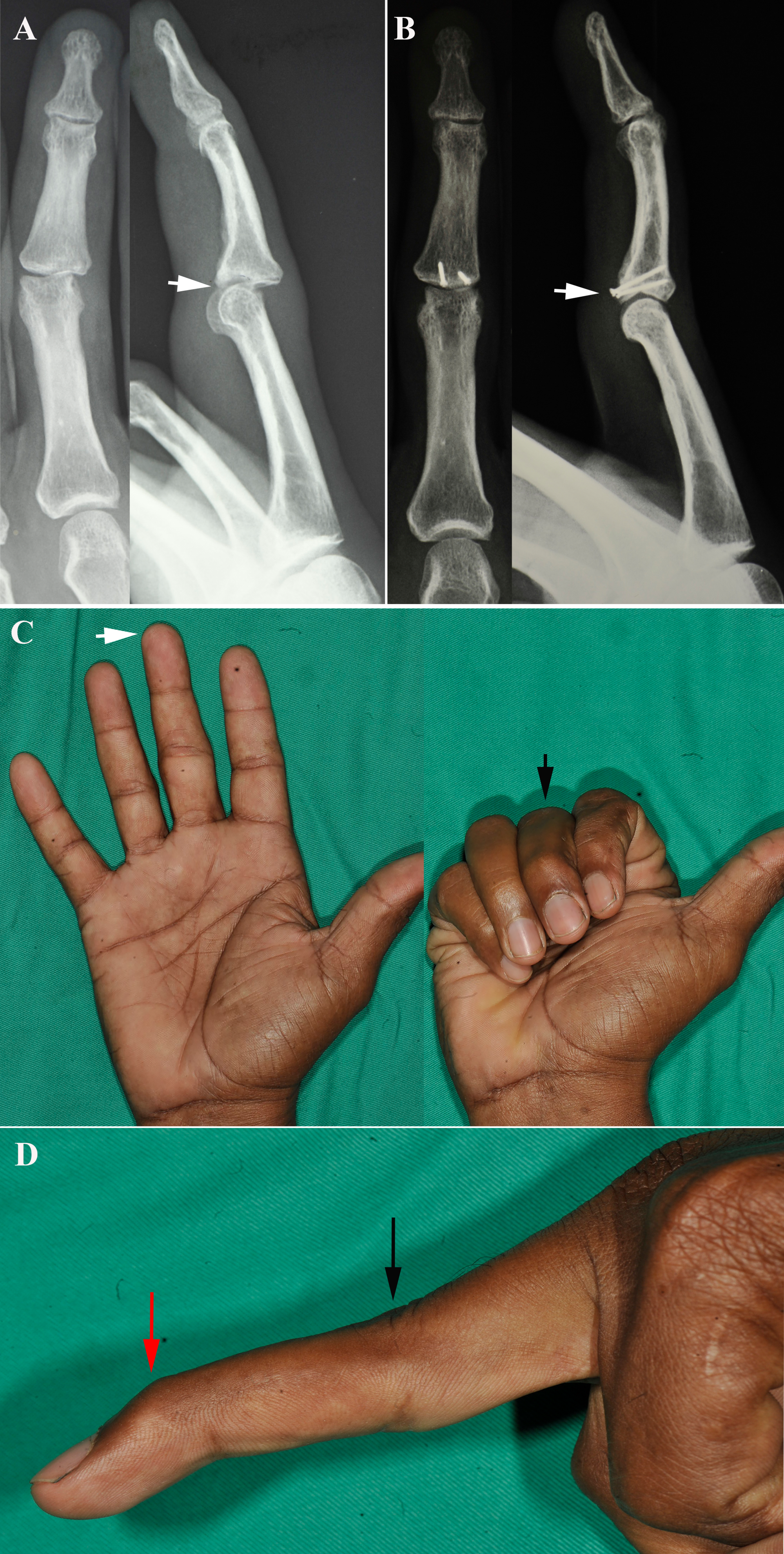 Cureus Hemihamate Arthroplasty in Chronic Fracturedislocation of