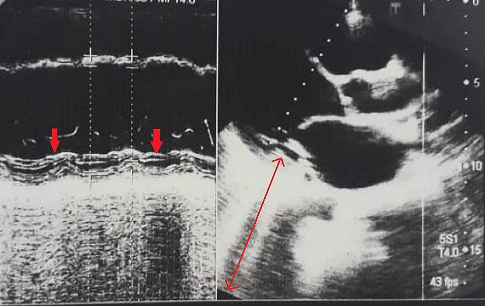 Cerebral Infarction Followed by Myocardial Infarction in a Young Adult with Protein C and S