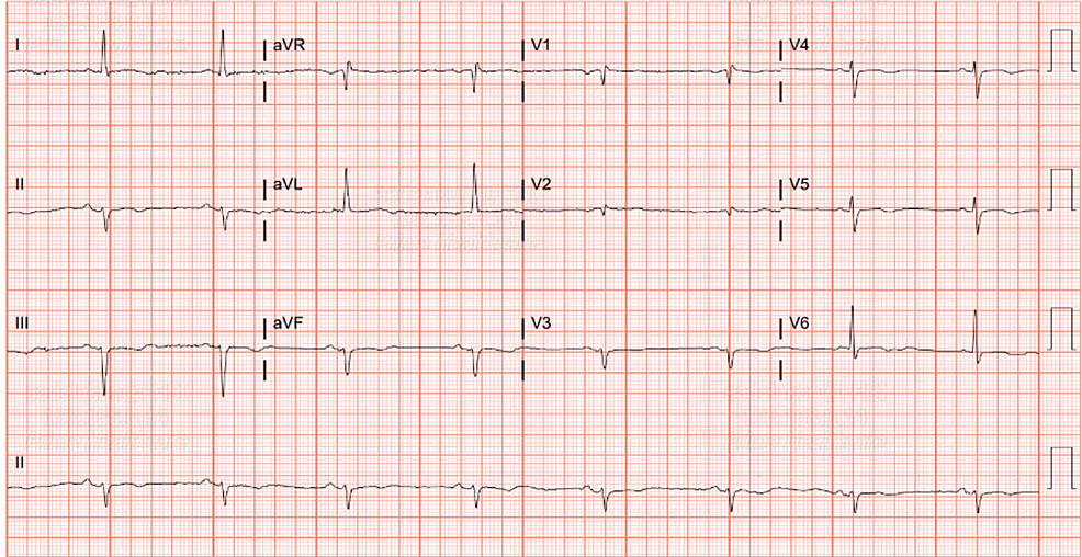 Black Cohosh: An Uncommon Culprit of Bradycardia in Postmenopausal ...