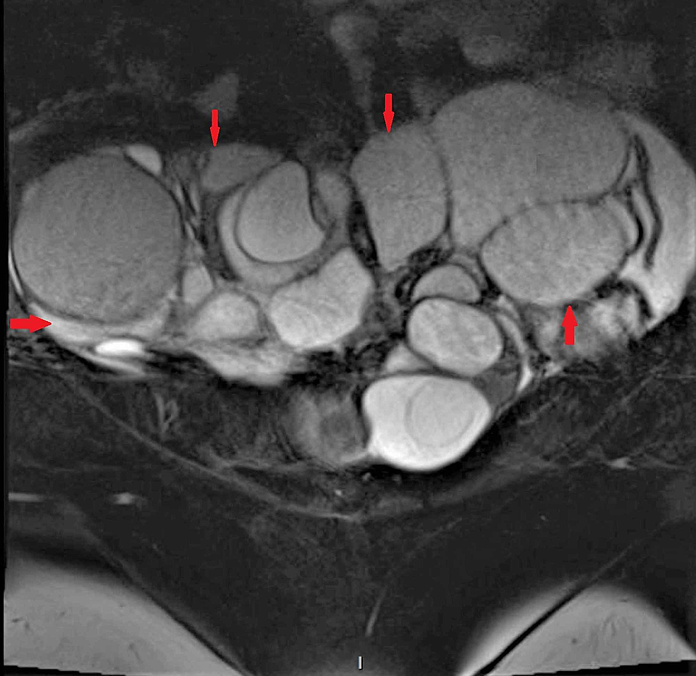 Coronal-section-of-the-patient's-pelvic-MRI-showing-severely-enlarged-bilateral-ovarian-masses-with-numerous-cystic-spaces-separated-by-thin-septations