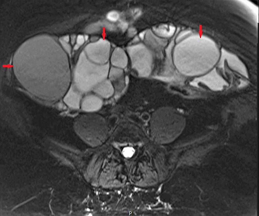 Transverse-section-of-the-patient's-pelvic-MRI-showing-severely-enlarged-bilateral-ovarian-masses-with-numerous-cystic-spaces-separated-by-thin-septations