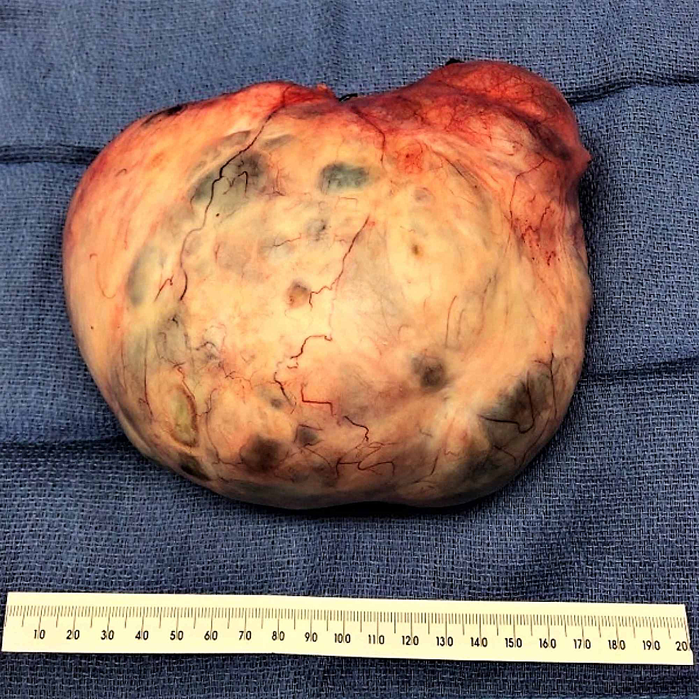 Postoperative-specimen-of-the-left-ovarian-mass-measuring-18-cm-X-14-cm-X-8-cm;-the-surface-is-intact-and-has-smooth-contours