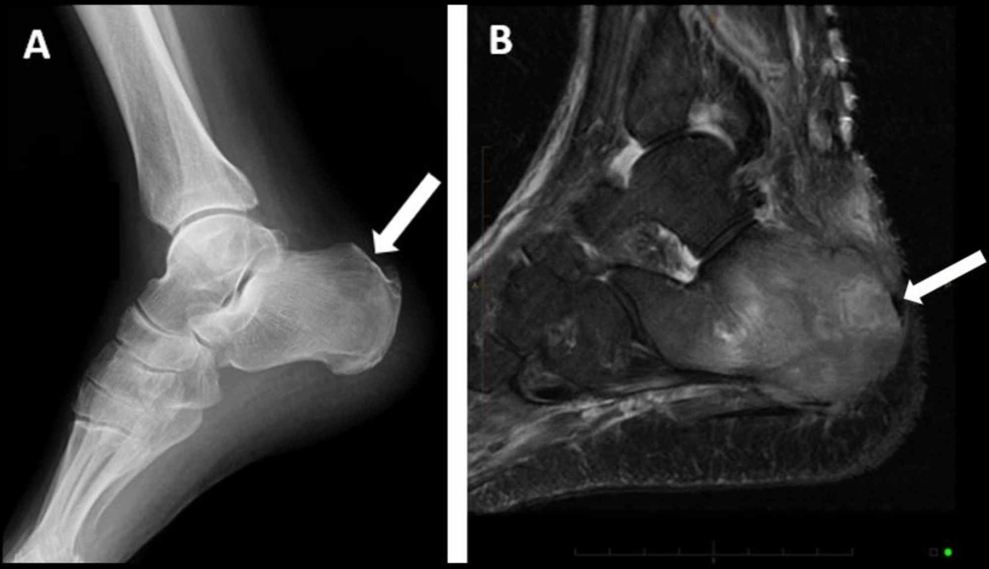 Cureus Multi focal Lytic Lesions In A Patient With Myelofibrosis A 