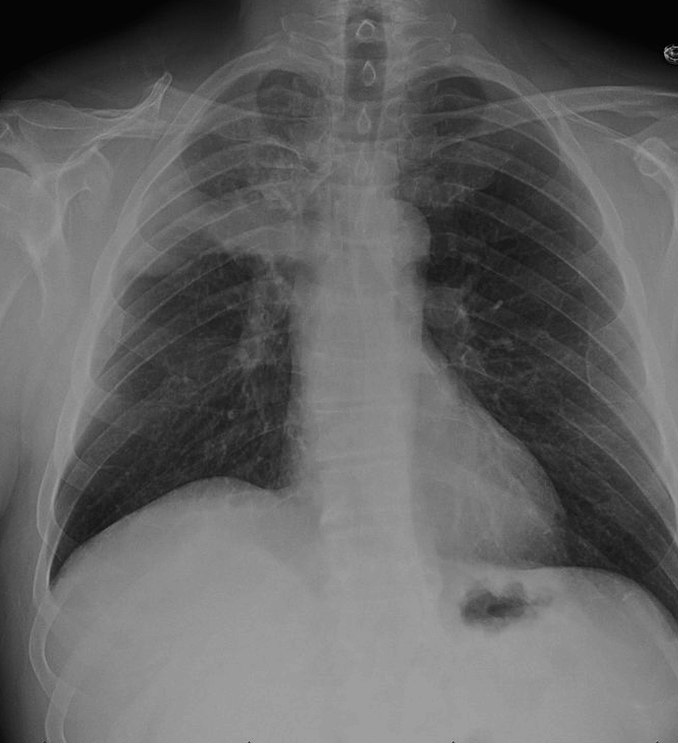 Cureus | An Aspirated Tooth Masquerading As Lung Cancer: A Unique Case ...