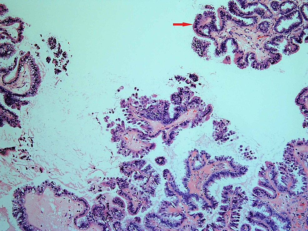 Bluish-cells-on-the-inner-surface-of-the-cystic-tumor,-indicating-their-serous-type