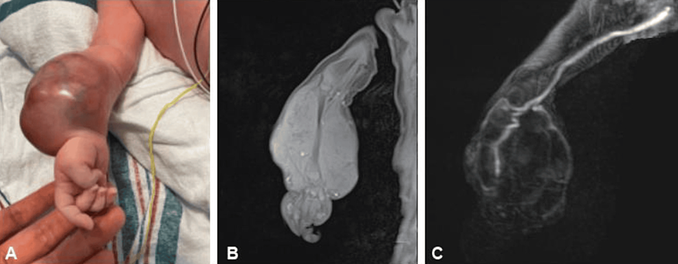 Cureus | Congenital Disseminated Malignant Rhabdoid Tumor Mimicking a ...