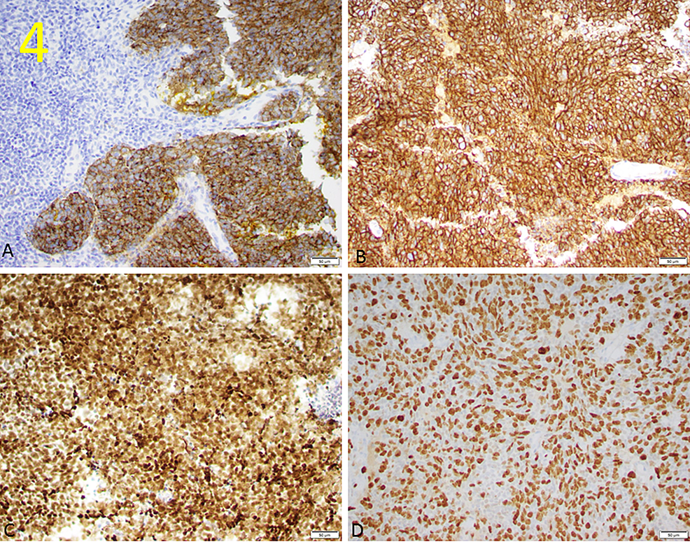 endo neurocrine cancer