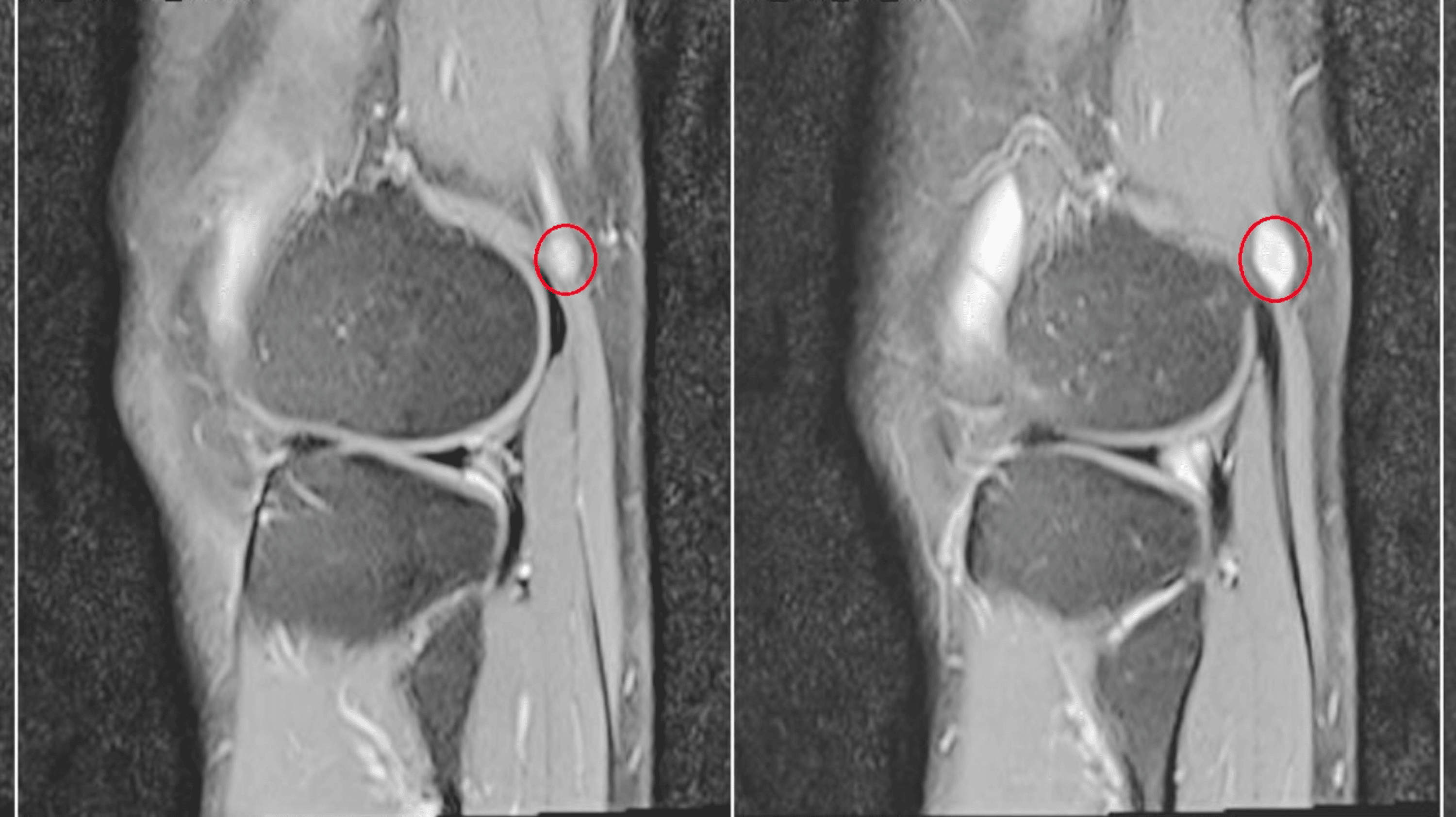 Cureus | A Curious Case of Common Peroneal Nerve Schwannoma