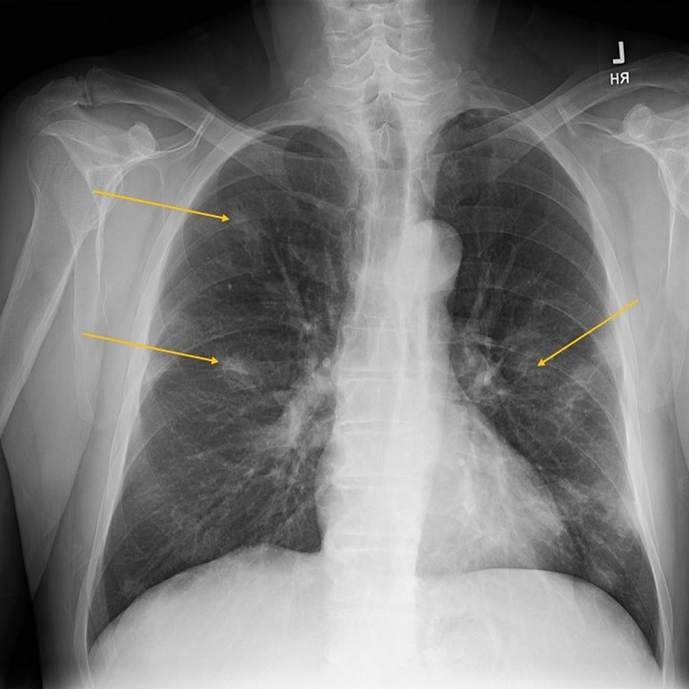 Cureus Disseminated Histoplasmosis with Concurrent Hairy Cell Leukemia