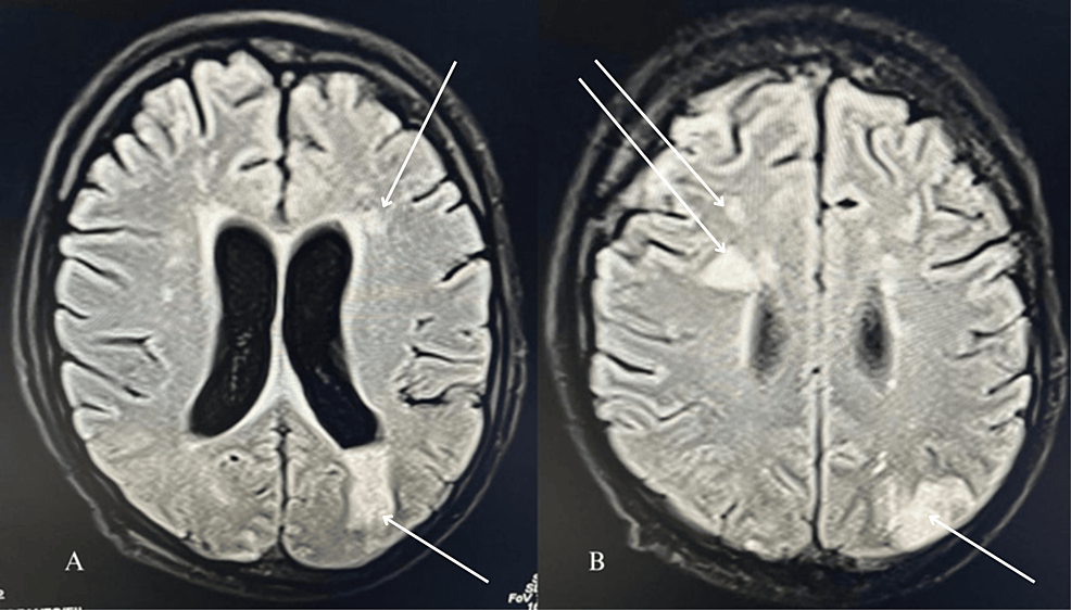 MRI-flair-sequence showing-multiple-septic-emboli-in-the-brain.