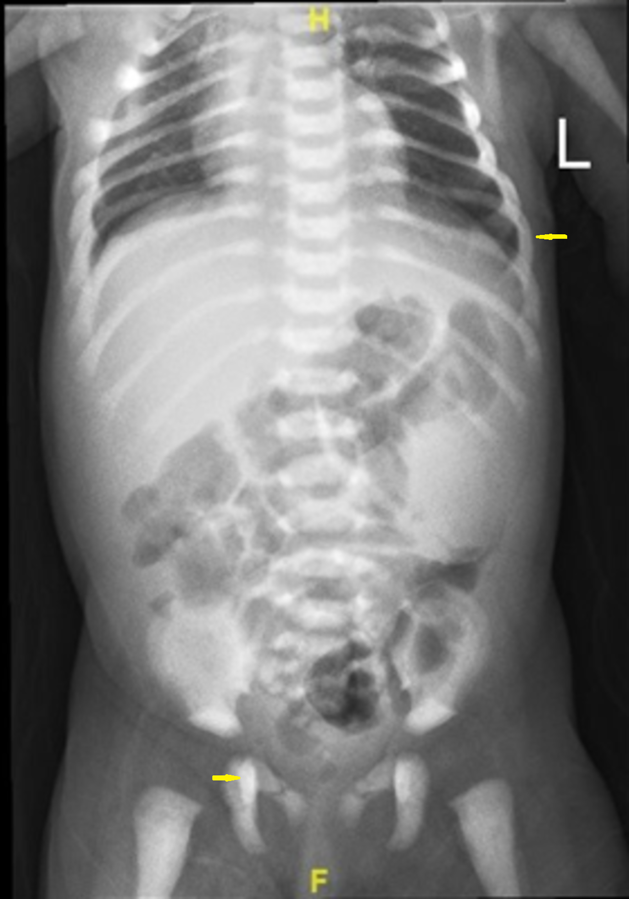 Cureus | Malignant Infantile Osteopetrosis: A Case Report