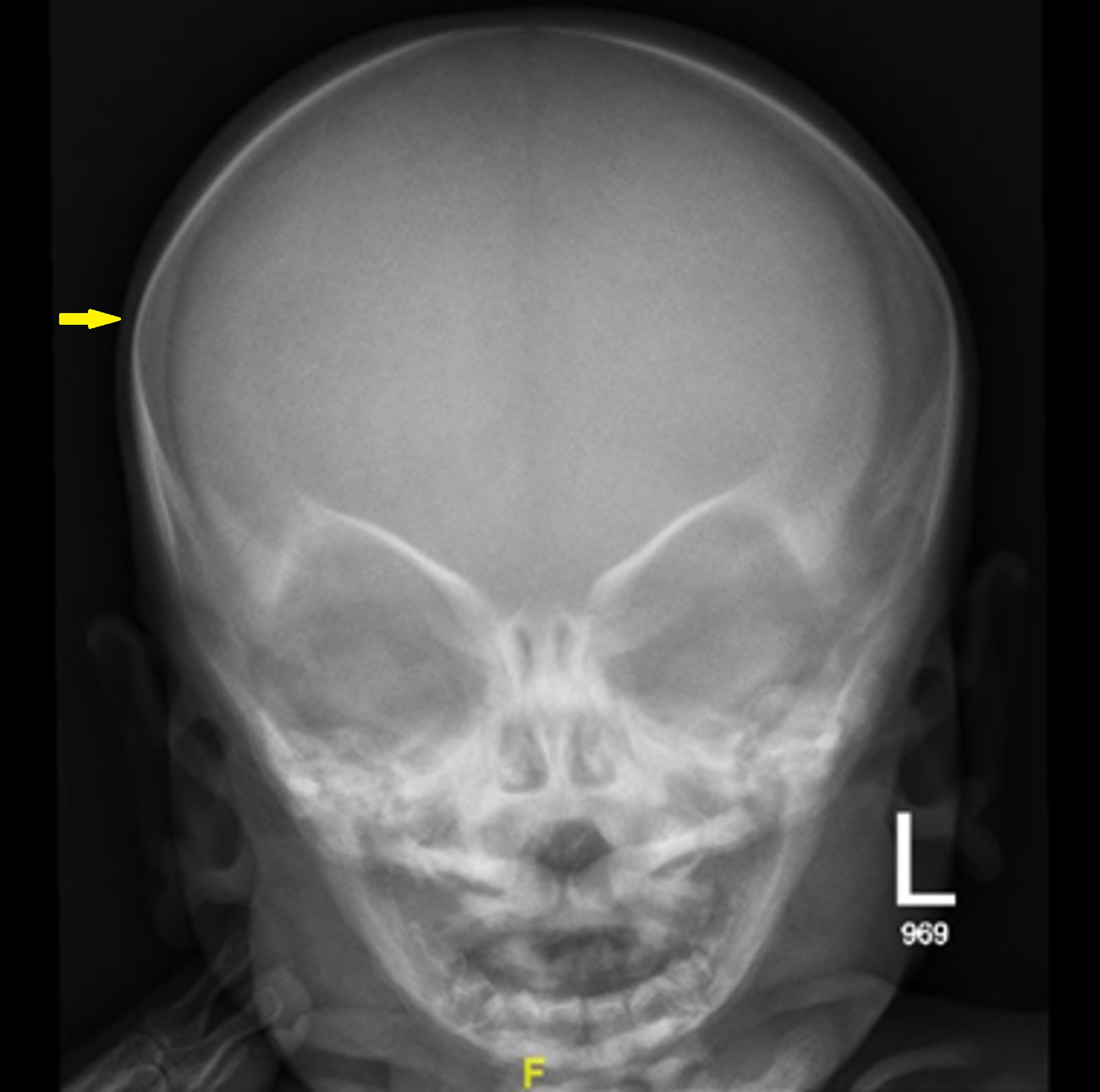 Cureus | Malignant Infantile Osteopetrosis: A Case Report