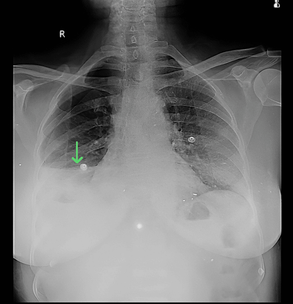 A-supine-anteroposterior-chest-X-ray-showing-right-side-hydropneumothorax
