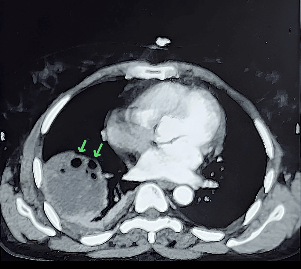 Contrast-enhanced-computed-tomography-scan-showing-a-well-defined-lesion-containing-multiple-air-foci-in-the-right-lower-lobe-of-the-lung