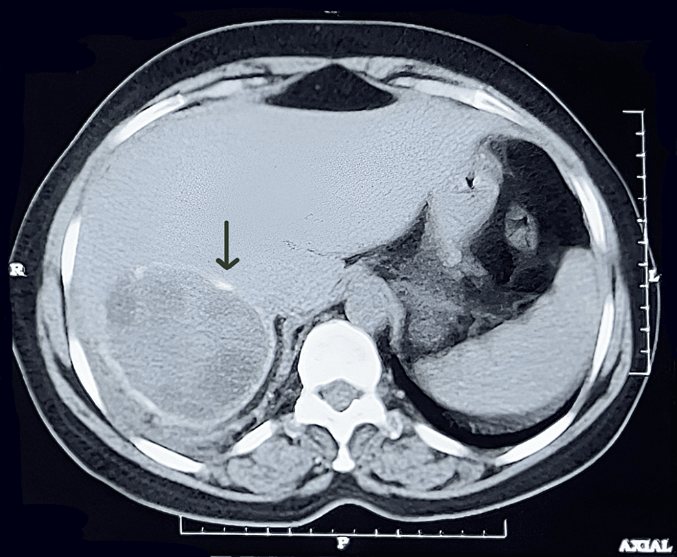 Contrast-enhanced-computed-tomography-scan-showing-a-well-defined-lesion-involving-segments-VI-and-VII-of-the-liver-containing-a-few-daughter-cysts