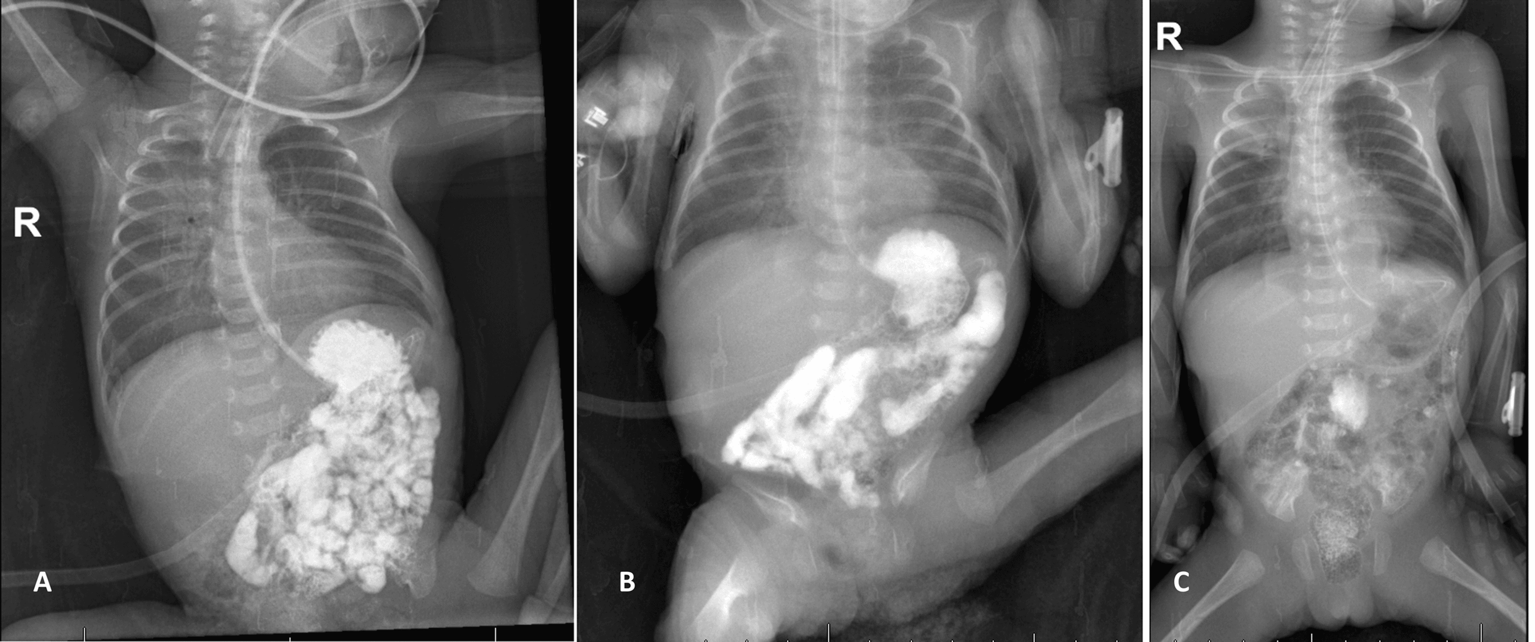 Perforated Meckel’s Diverticulum and Adhesive Intestinal Obstruction in