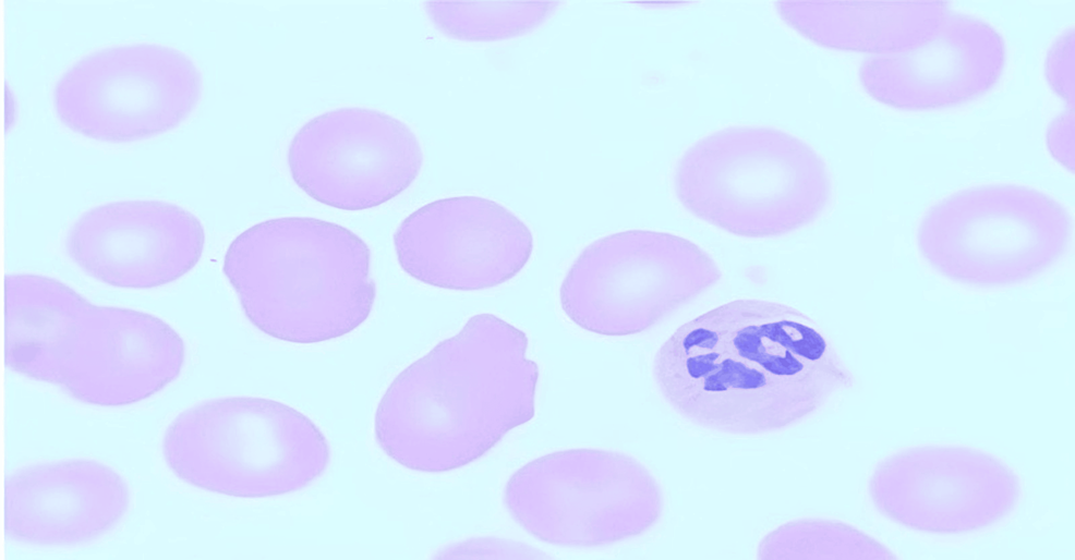 Peripheral-smear-with-macrocytes-and-hyper-segmented-neutrophil-(magnification---100X).