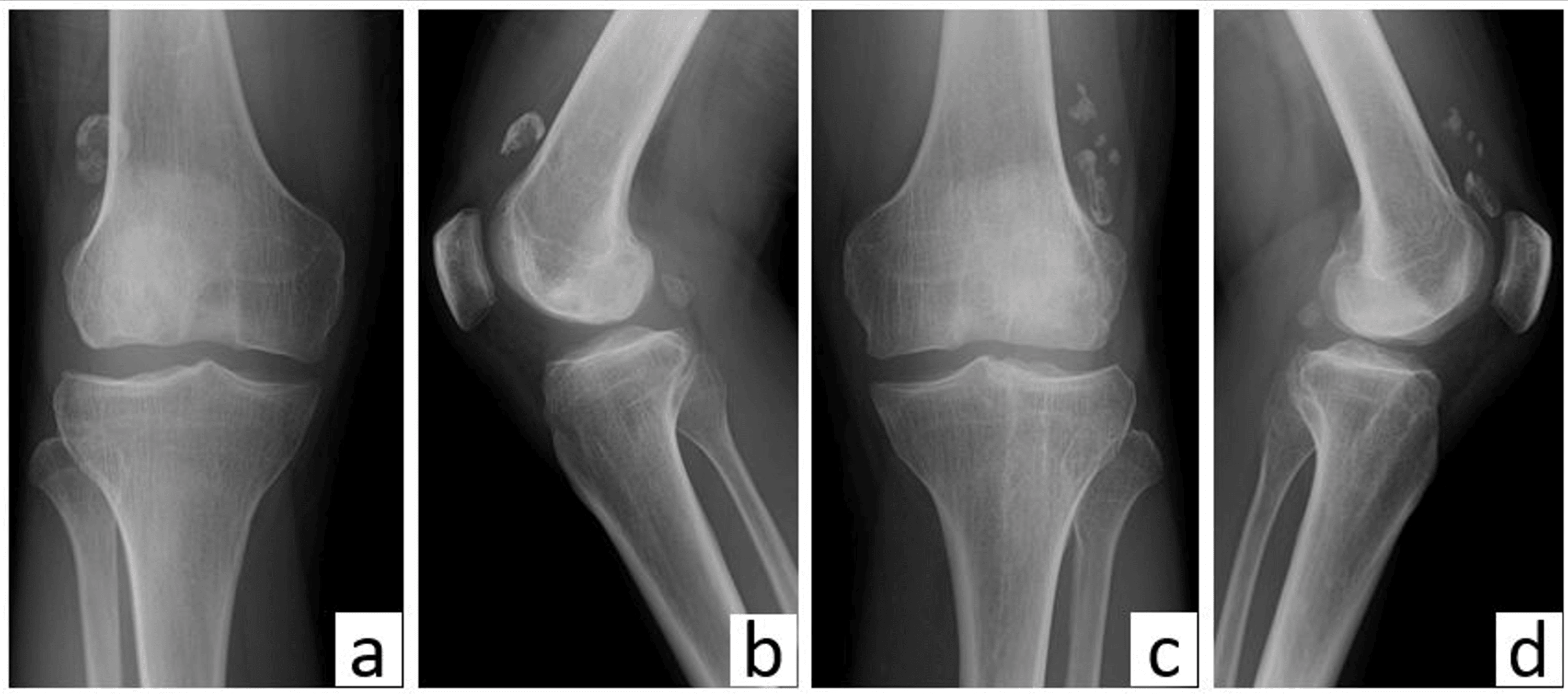 Multiple Epiphyseal Dysplasia With Knee Joint Locking Symptoms Caused 