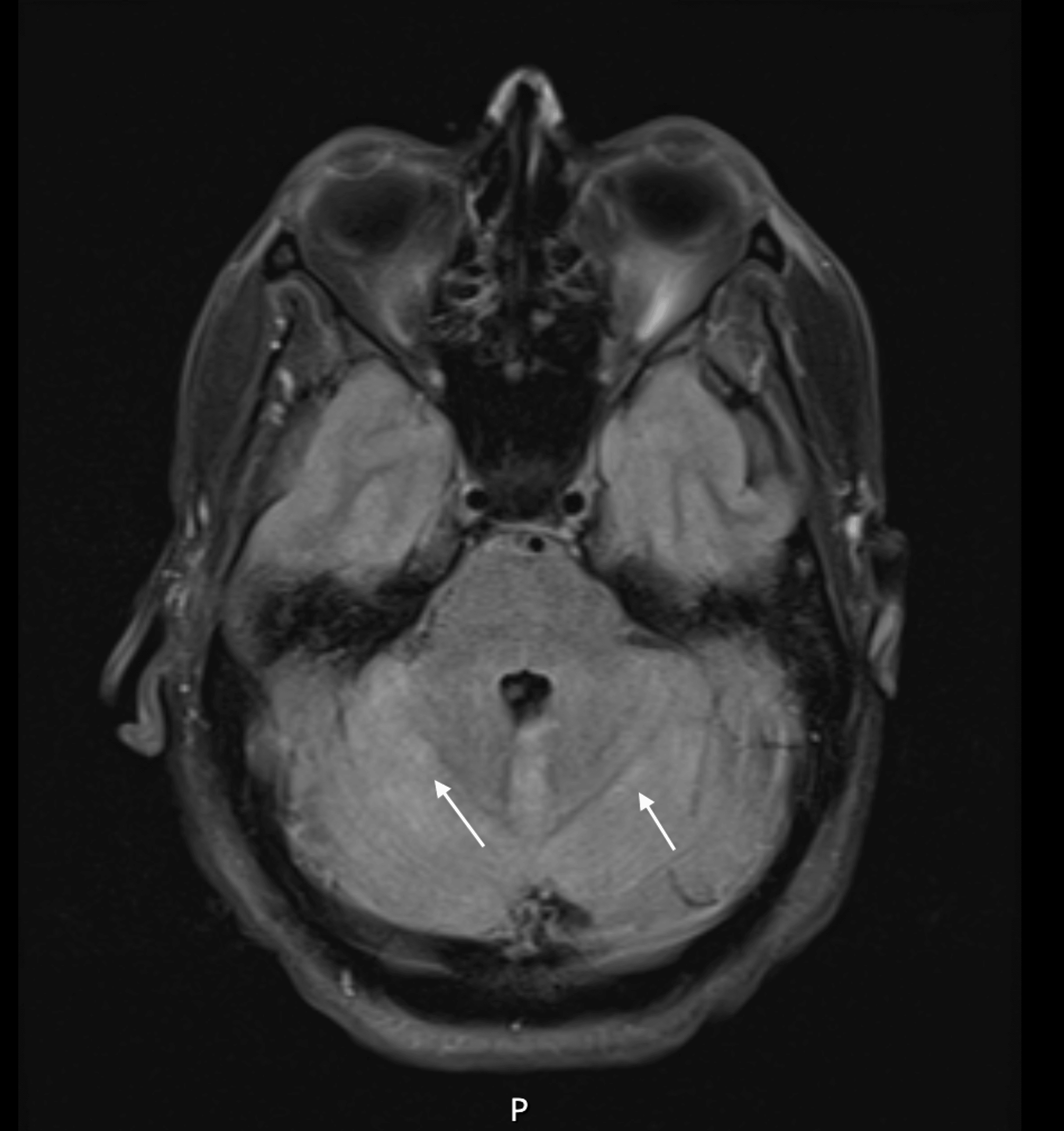 Rehabilitation Outcomes in Multiple Sclerosis Patients on Ocrelizumab ...