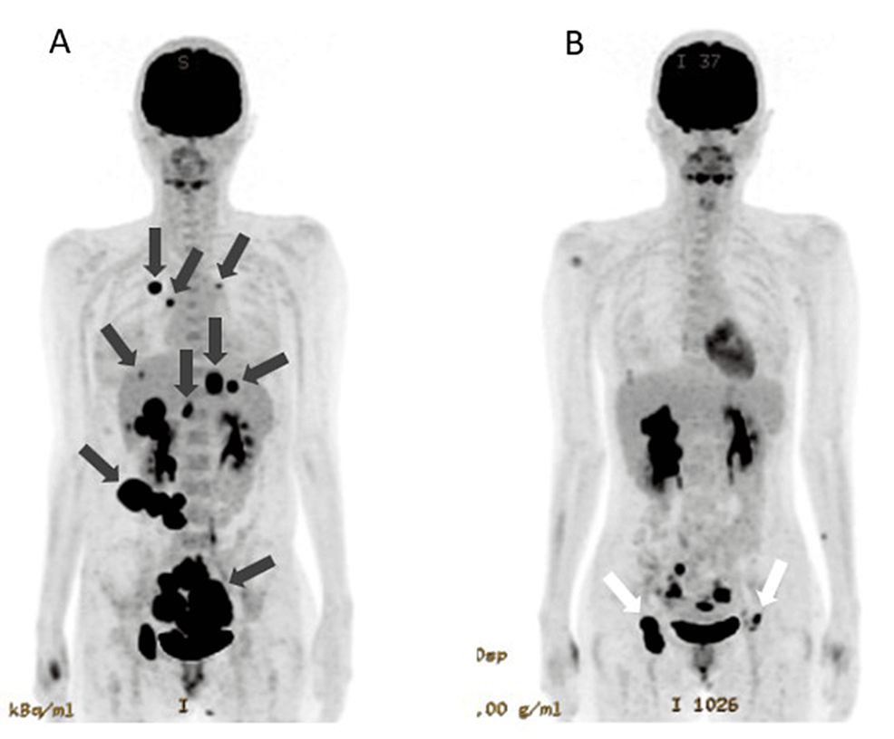 Cureus | Late-Stage Ovarian Cancer With Systemic Multiple Metastases ...