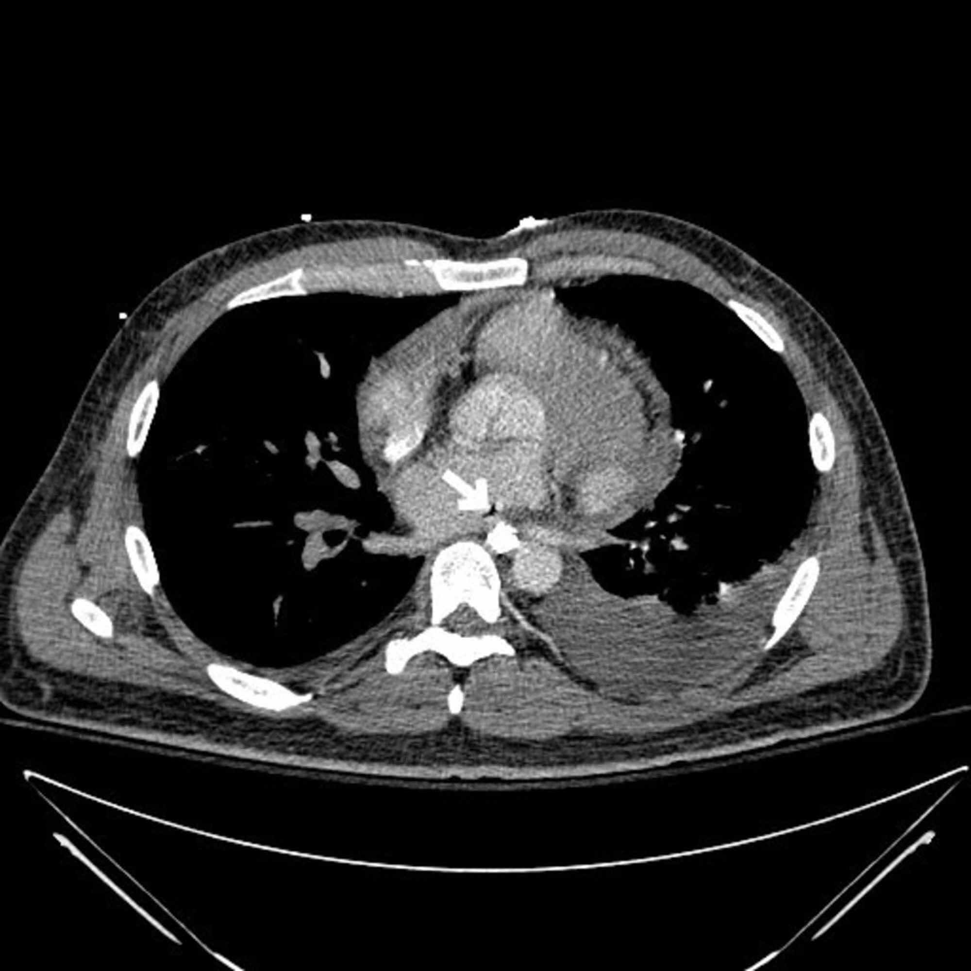 Cureus A Rare Complication of Cardiac Ablation Atrialesophageal