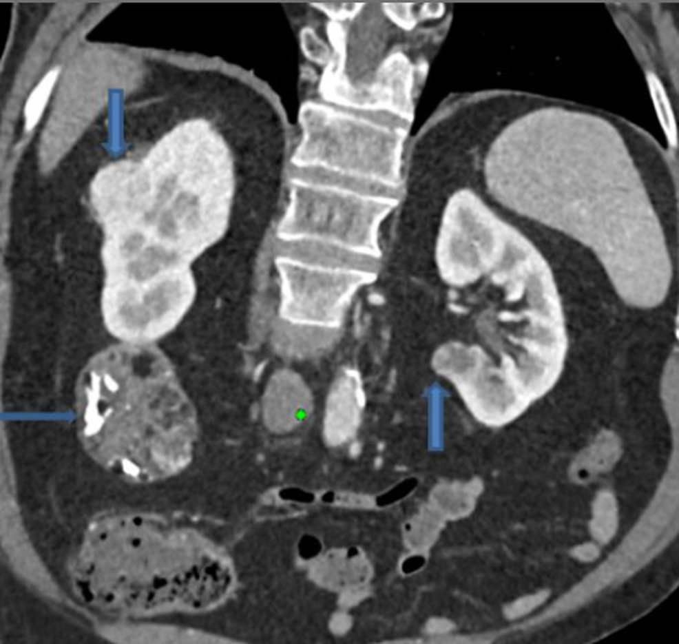 Cureus Fat Containing Renal Cell Carcinoma Mimicking Angiomyolipoma A Radiological And