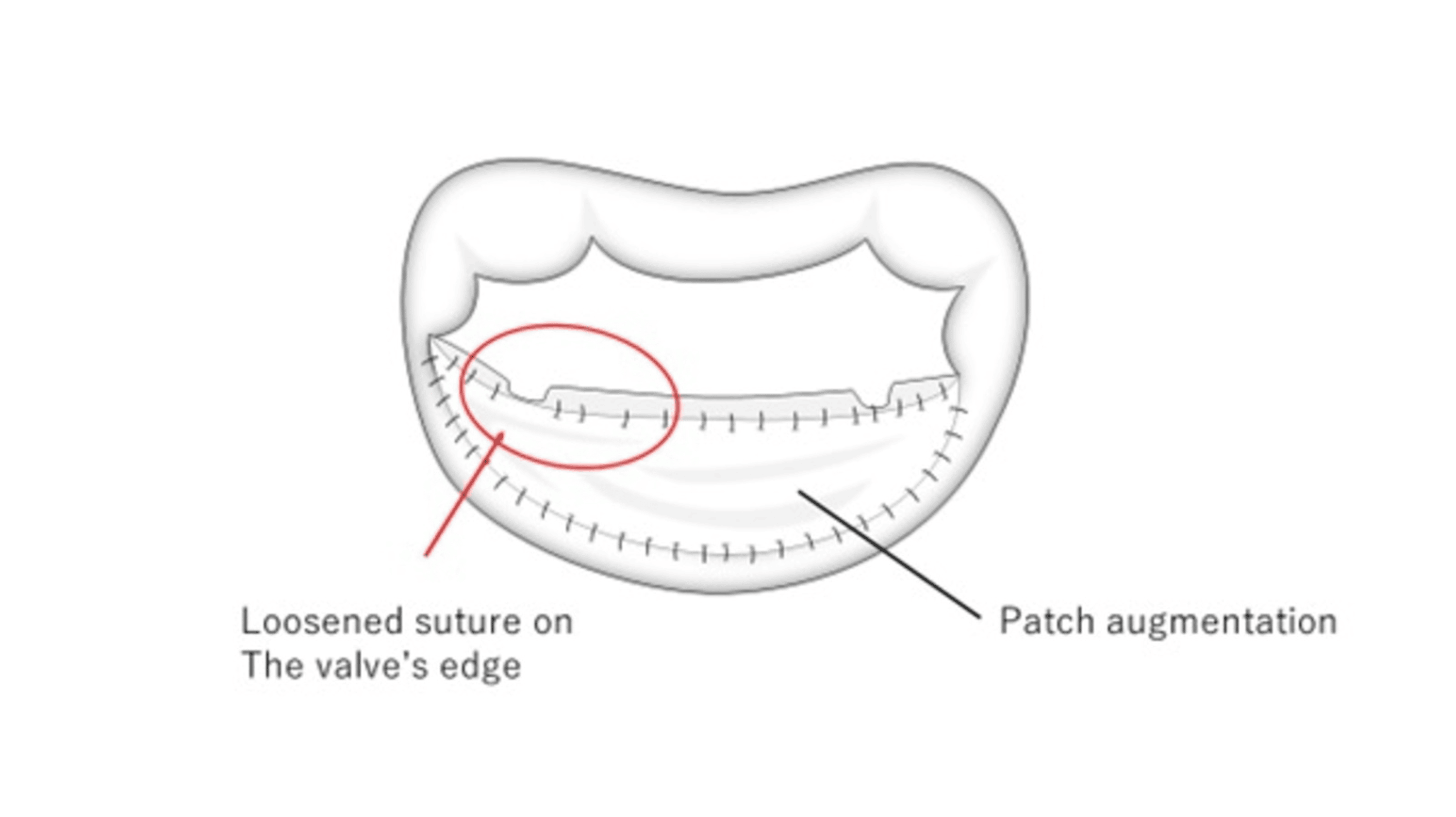 Patch Dehiscence After Mitral Valve Repair by Posterior Mitral Leaflet