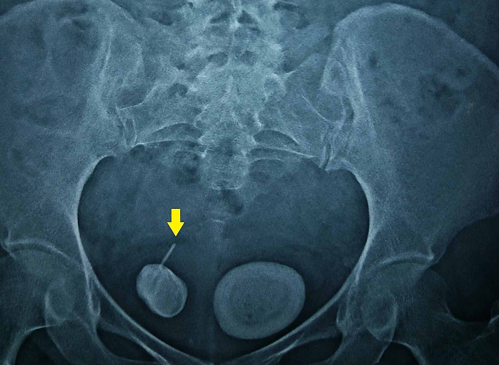 cureus-an-unusual-cause-of-vesical-calculi