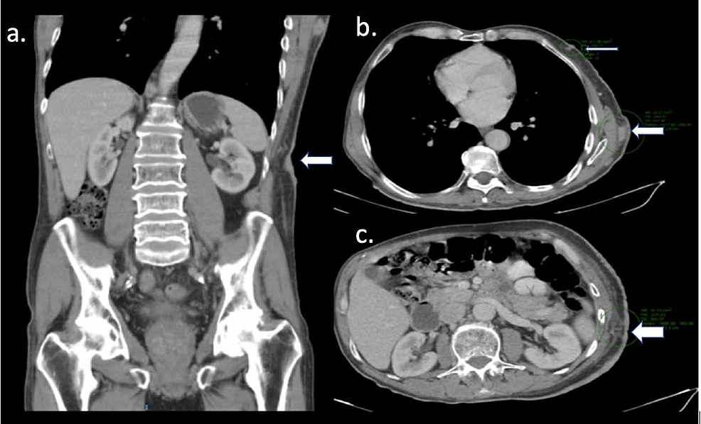 Cureus | Eccrine Porocarcinoma with Zosteriform Metastasis