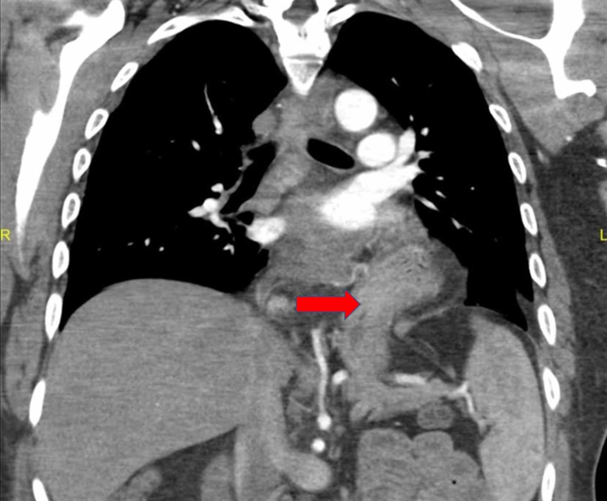 Cureus Does Smoking Cannabis Increase the Risk of Barrett’s Esophagus?