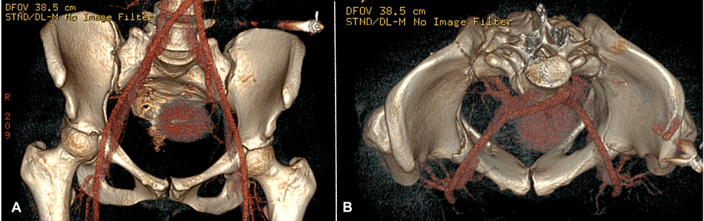 Double Trouble: Exploring Bilateral Acetabular Fractures in a