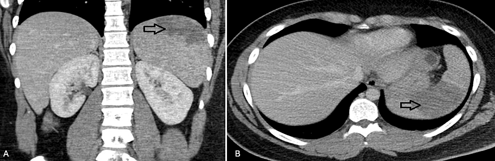 Cureus Splenic Infarction Due to Epstein Barr Virus A Case