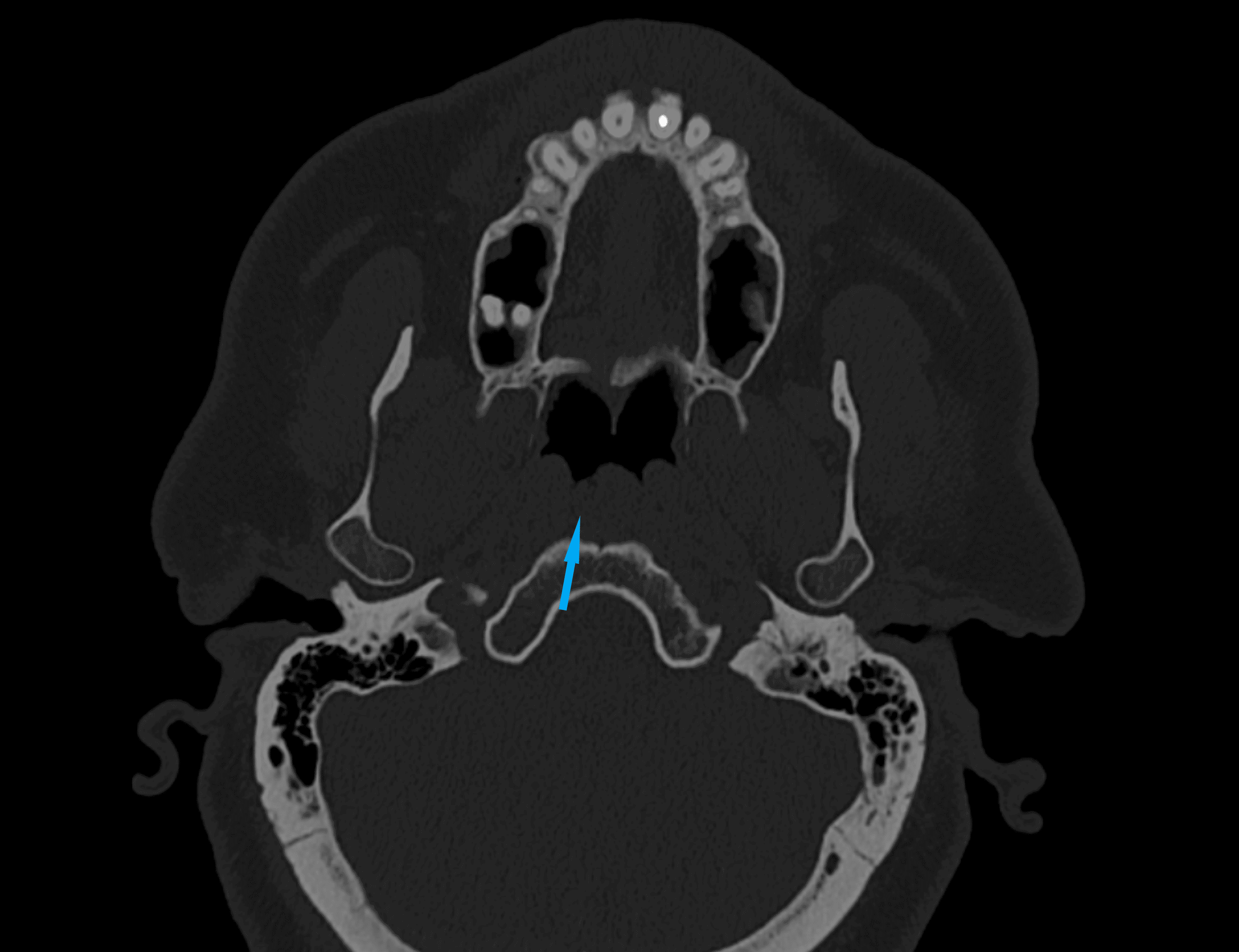 symptomatic-tornwaldt-cyst-a-case-report-cureus