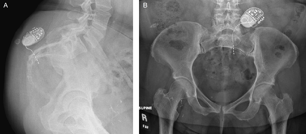 Twiddler’s Syndrome Causing Lead Fracture In Sacral Neuromodulation A Case Report Cureus