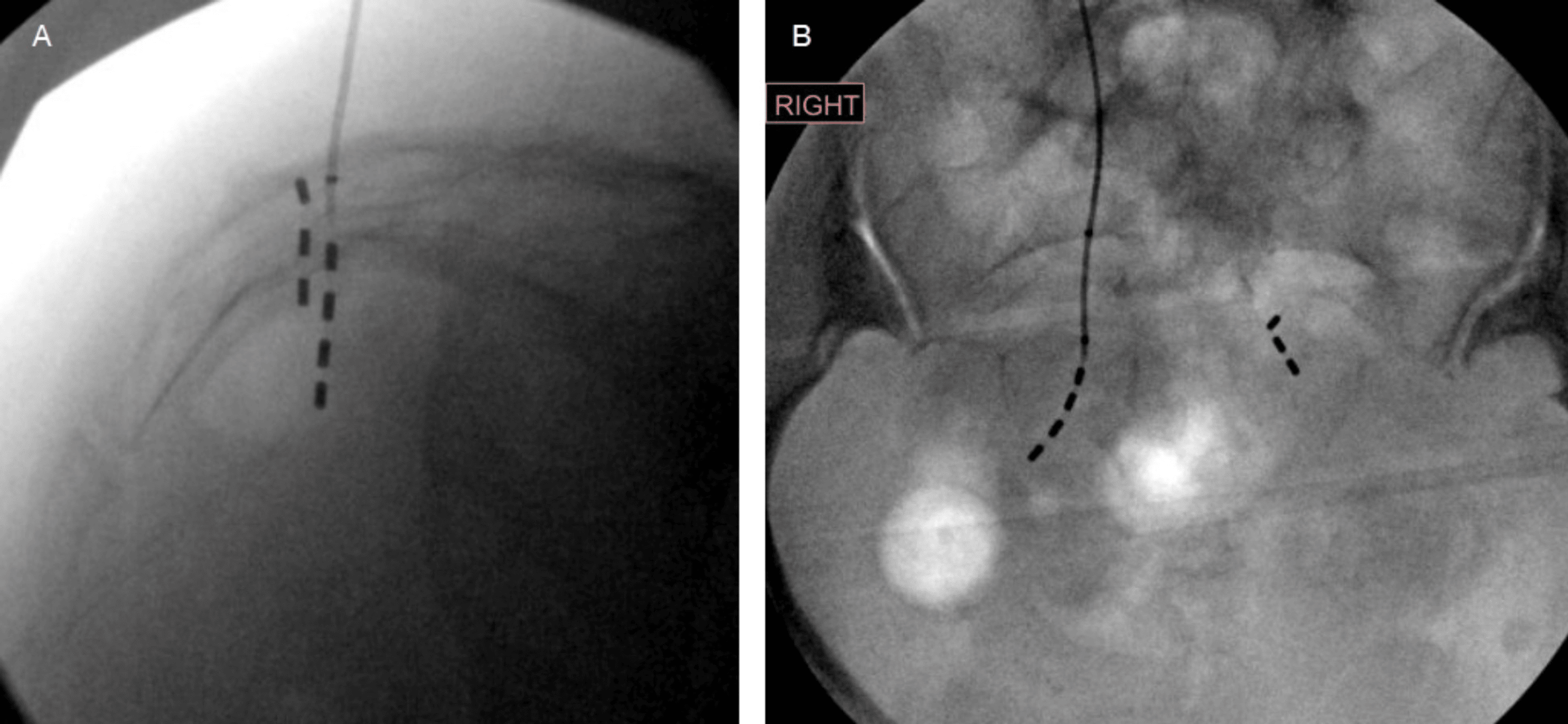 Twiddler’s Syndrome Causing Lead Fracture In Sacral Neuromodulation A Case Report Cureus