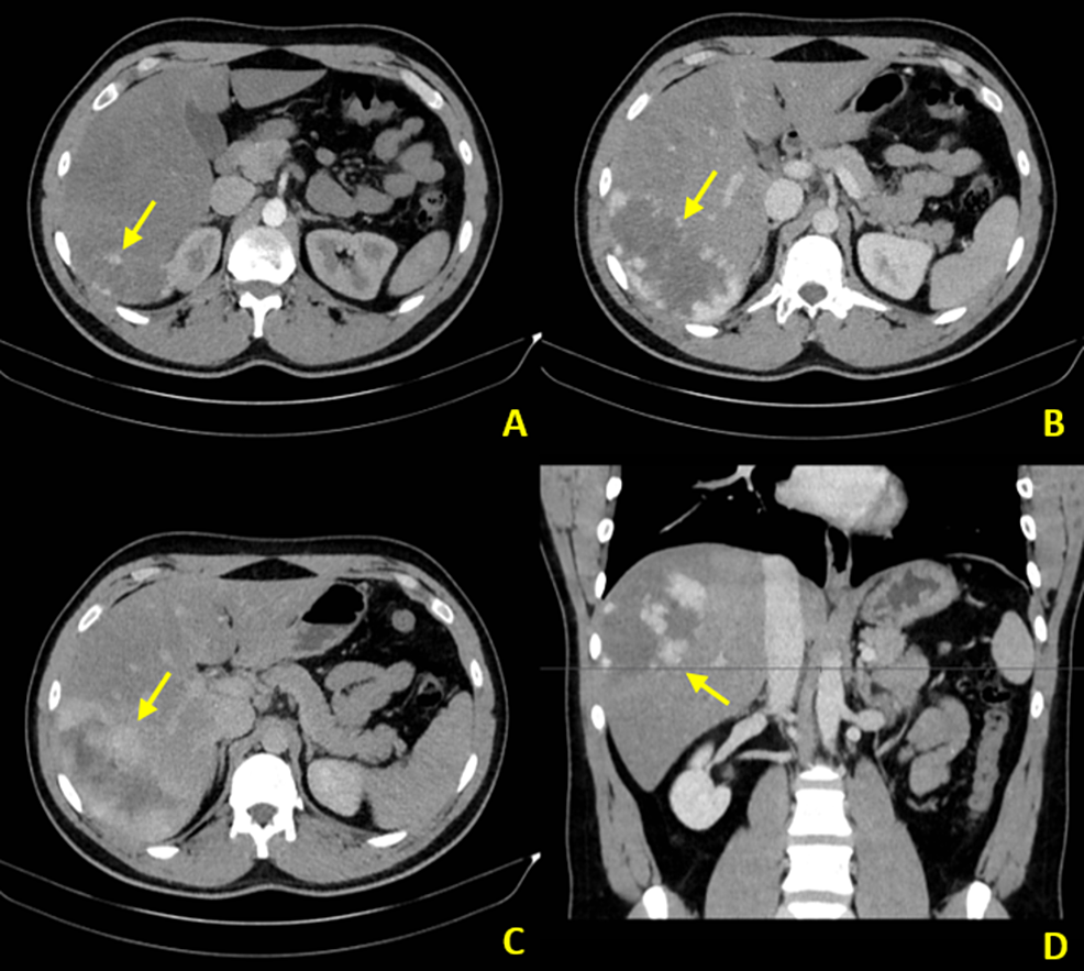 Cureus | A Review Of Benign Hepatic Tumors And Their Imaging ...