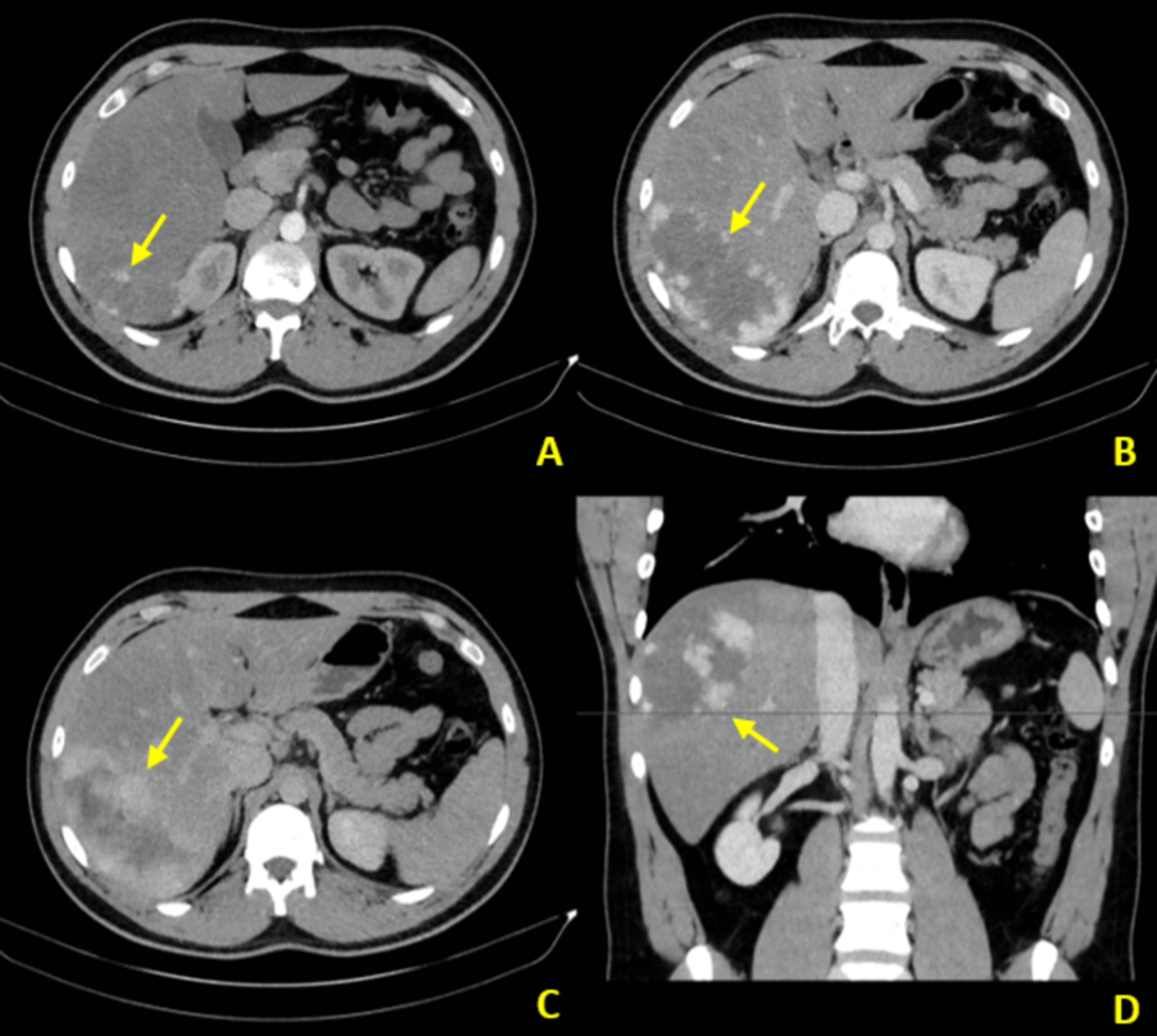 cureus-a-review-of-benign-hepatic-tumors-and-their-imaging