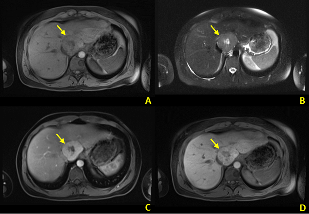 Cureus | A Review of Benign Hepatic Tumors and Their Imaging ...