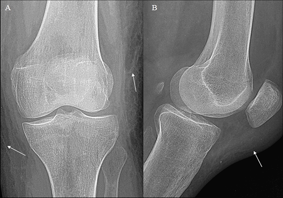 Cureus | Prepatellar Morel-Lavallée Effusion Mimicking a Bursitis