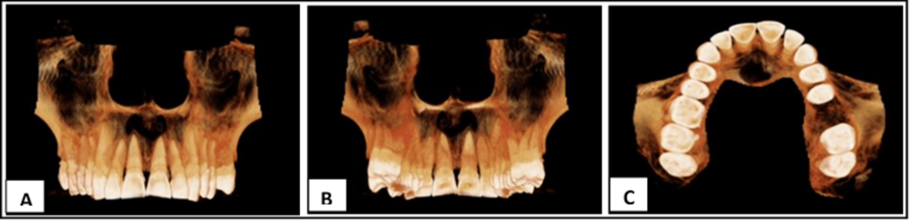 The Surgical Management Of A Radicular Cyst In The Maxillary Anterior Region A Case Report 2274